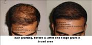 Before After Pictures,Photos,Delhi,hair transplantation 